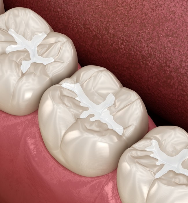 composite-dental-fillings-hamptons-dental