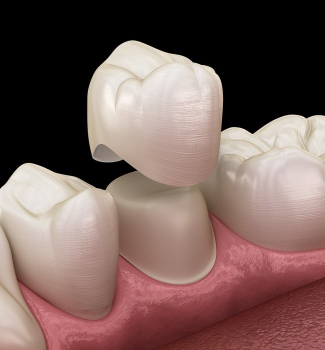 dental-crowns-hamptons-dental