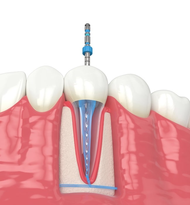 endodontics-hamptons-dental