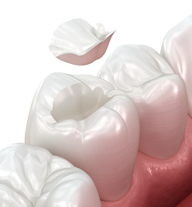 inlays-and-onlays-hamptons-dental