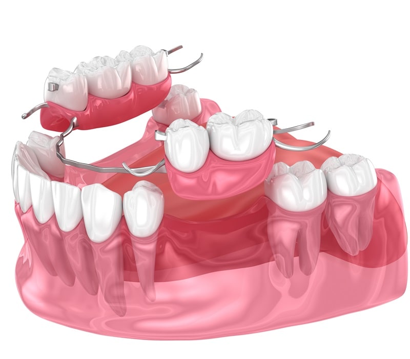 prosthodontics-hamptons-dental